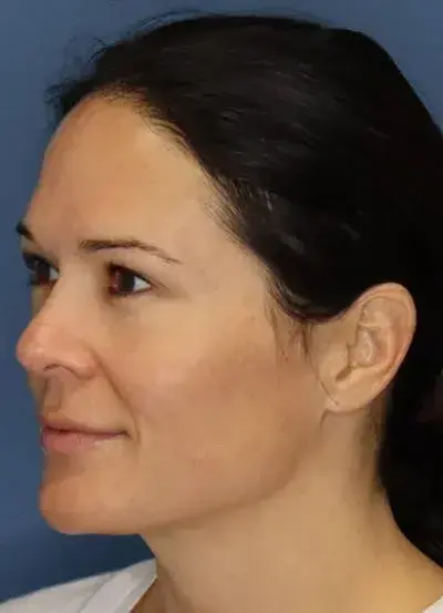 South Coast Plastic Surgery Ladera Ranch laser treatment after — Ladera Ranch, CA
