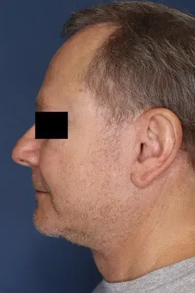 Neck Lift after at South Coast Plastic Surgery Ladera Ranch in Ladera Ranch, CA