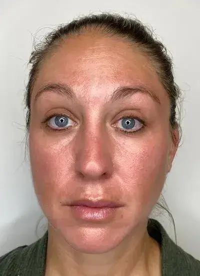 Chemical Peel after at South Coast Plastic Surgery Ladera Ranch in Ladera Ranch, CA