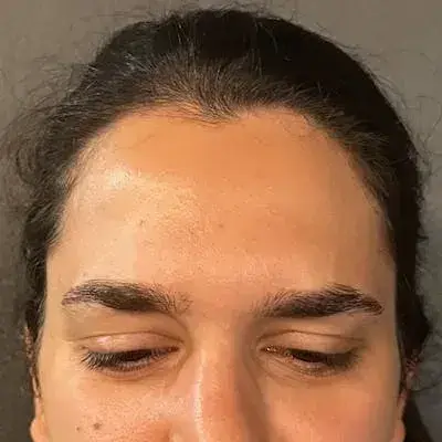 South Coast Plastic Surgery Ladera Ranch botox after — Ladera Ranch, CA