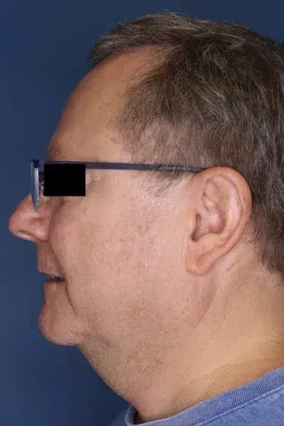 Neck Lift before at South Coast Plastic Surgery Ladera Ranch in Ladera Ranch, CA