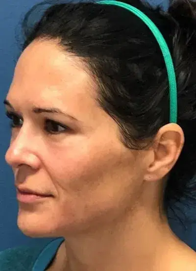 Laser Skin Resurfacing before at South Coast Plastic Surgery Ladera Ranch in Ladera Ranch, CA