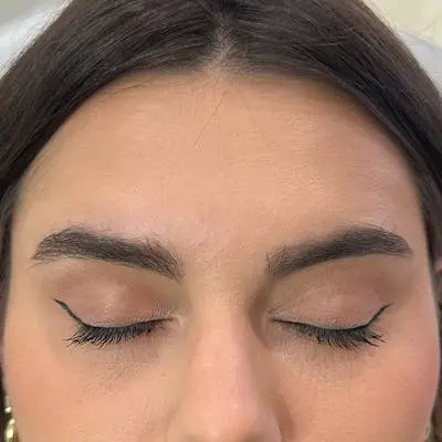 South Coast Plastic Surgery Ladera Ranch botox after — Ladera Ranch, CA