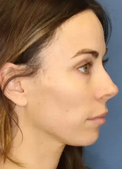 South Coast Plastic Surgery Ladera Ranch laser treatment after — Ladera Ranch, CA