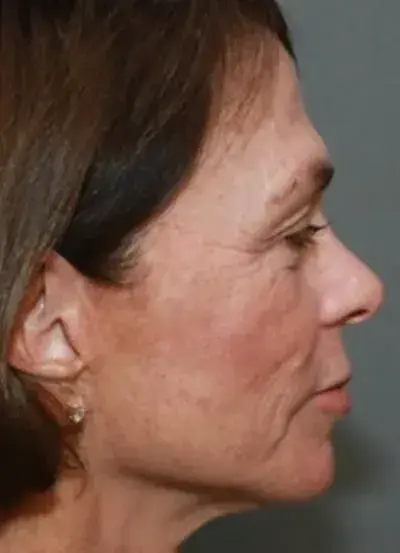 South Coast Plastic Surgery Ladera Ranch laser treatment after — Ladera Ranch, CA