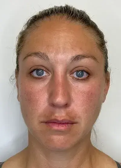 Chemical Peel before at South Coast Plastic Surgery Ladera Ranch in Ladera Ranch, CA