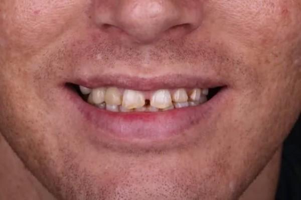 Smile Makeover before at Fort Worth Cosmetic & Family Dentistry in Fort Worth, TX