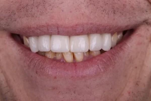 Fort Worth Cosmetic & Family Dentistry smile makeover after — Fort Worth, TX