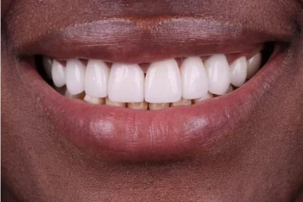 Fort Worth Cosmetic & Family Dentistry smile makeover after — Fort Worth, TX