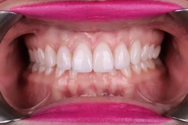 Fort Worth Cosmetic & Family Dentistry smile makeover after — Fort Worth, TX