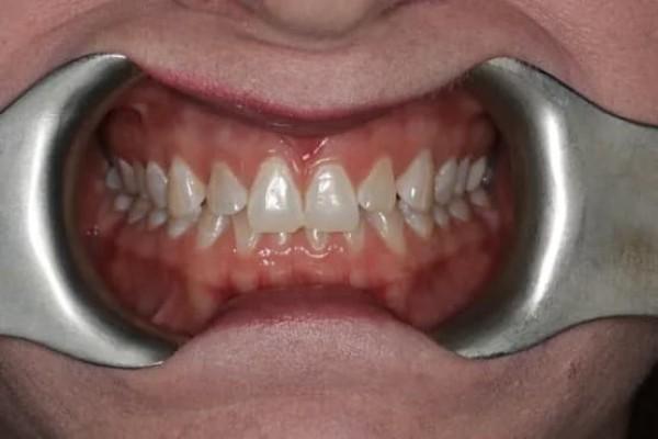 Smile Makeover before at Fort Worth Cosmetic & Family Dentistry in Fort Worth, TX