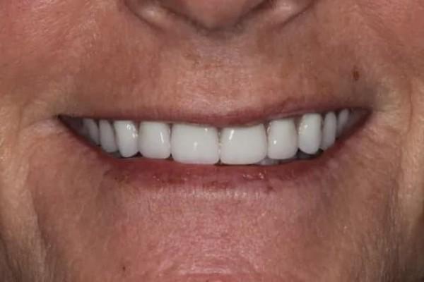 Fort Worth Cosmetic & Family Dentistry smile makeover after — Fort Worth, TX