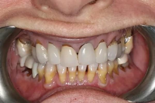 Smile Makeover before at Fort Worth Cosmetic & Family Dentistry in Fort Worth, TX
