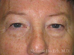 Dr. Howard Conn, M.D. - Laser Cosmetic and Ocular Plastic Surgeon blepharoplasty after — Irvine, CA