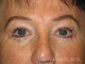 Blepharoplasty before at Dr. Howard Conn, M.D. - Laser Cosmetic and Ocular Plastic Surgeon in Irvine, CA