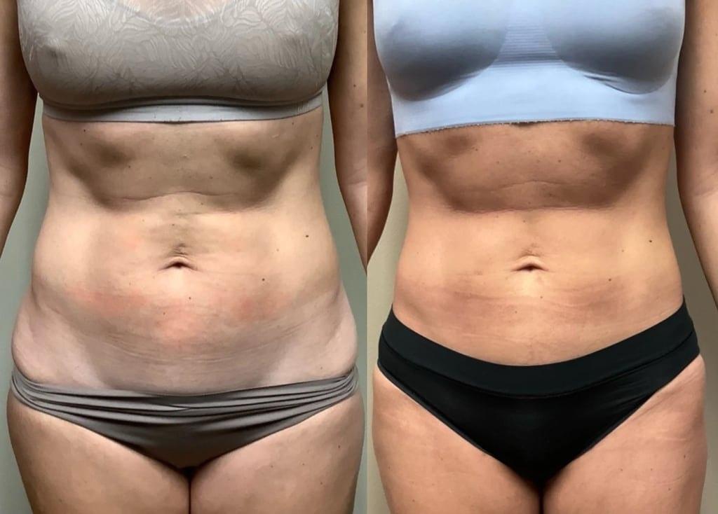 Remington Plastic Surgery liposuction result — Kirkland, WA