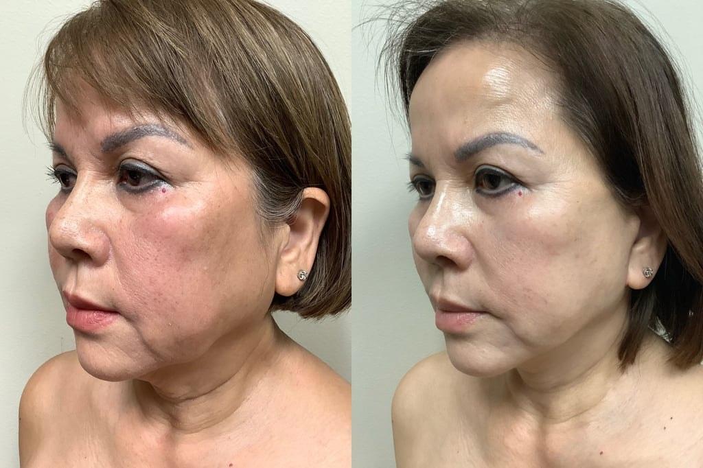 Remington Plastic Surgery facelift result — Kirkland, WA