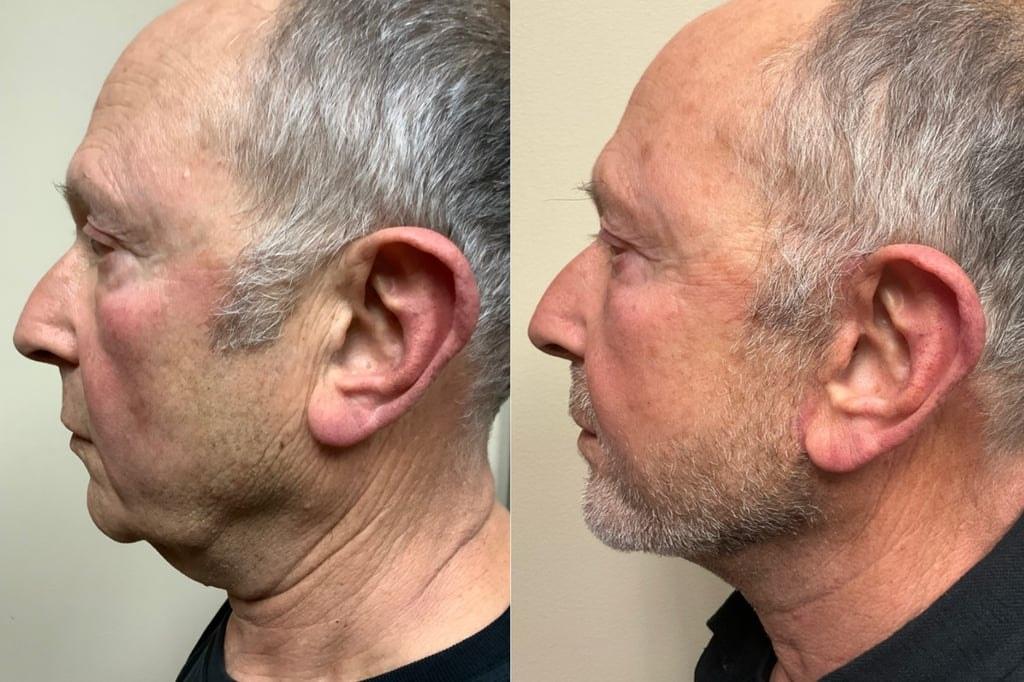 Remington Plastic Surgery facelift result — Kirkland, WA