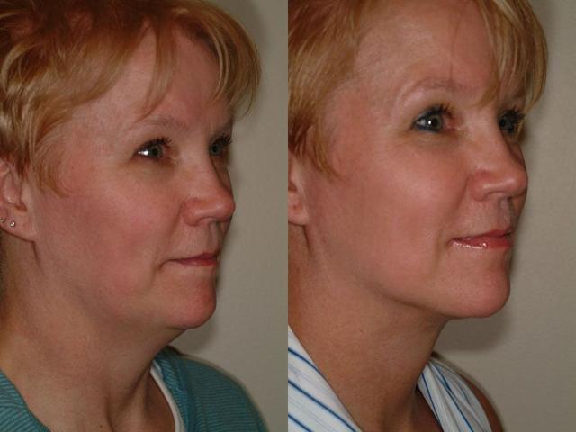 Neck Liposuction result at Remington Plastic Surgery in Kirkland, WA