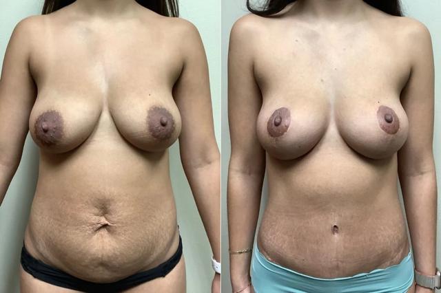 Mommy Makeover result at Remington Plastic Surgery in Kirkland, WA