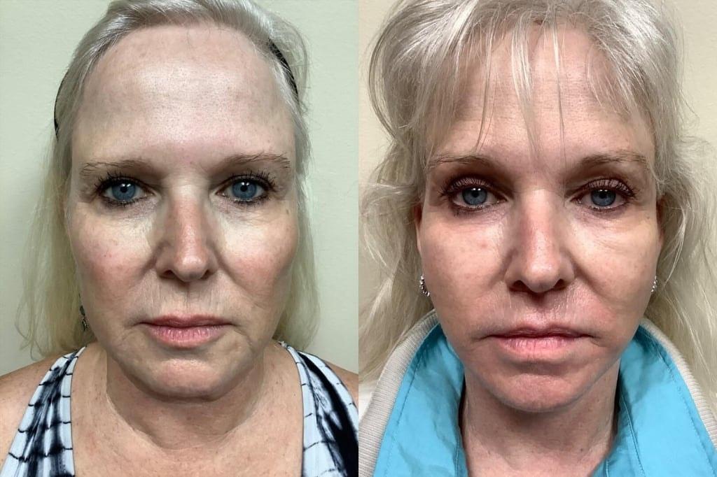 Remington Plastic Surgery facelift result — Kirkland, WA