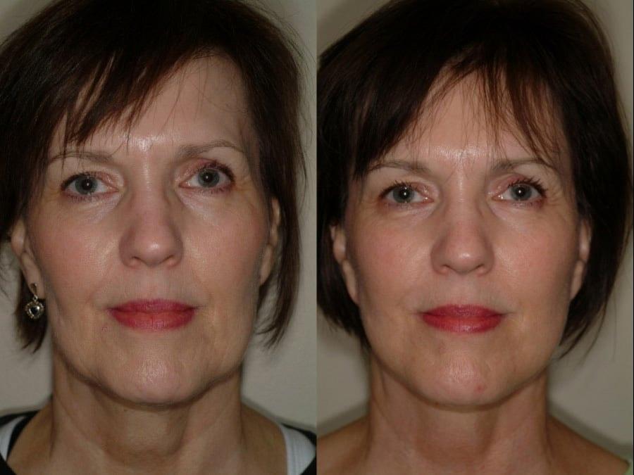 Remington Plastic Surgery facelift result — Kirkland, WA