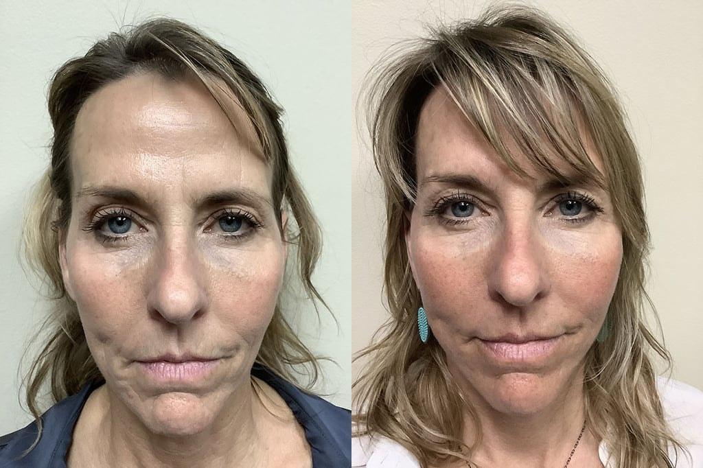 Remington Plastic Surgery facelift result — Kirkland, WA