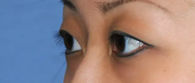 Blepharoplasty before at Aesthetic Facial Plastic Surgery – Dr. Philip Young MD in Bellevue, WA