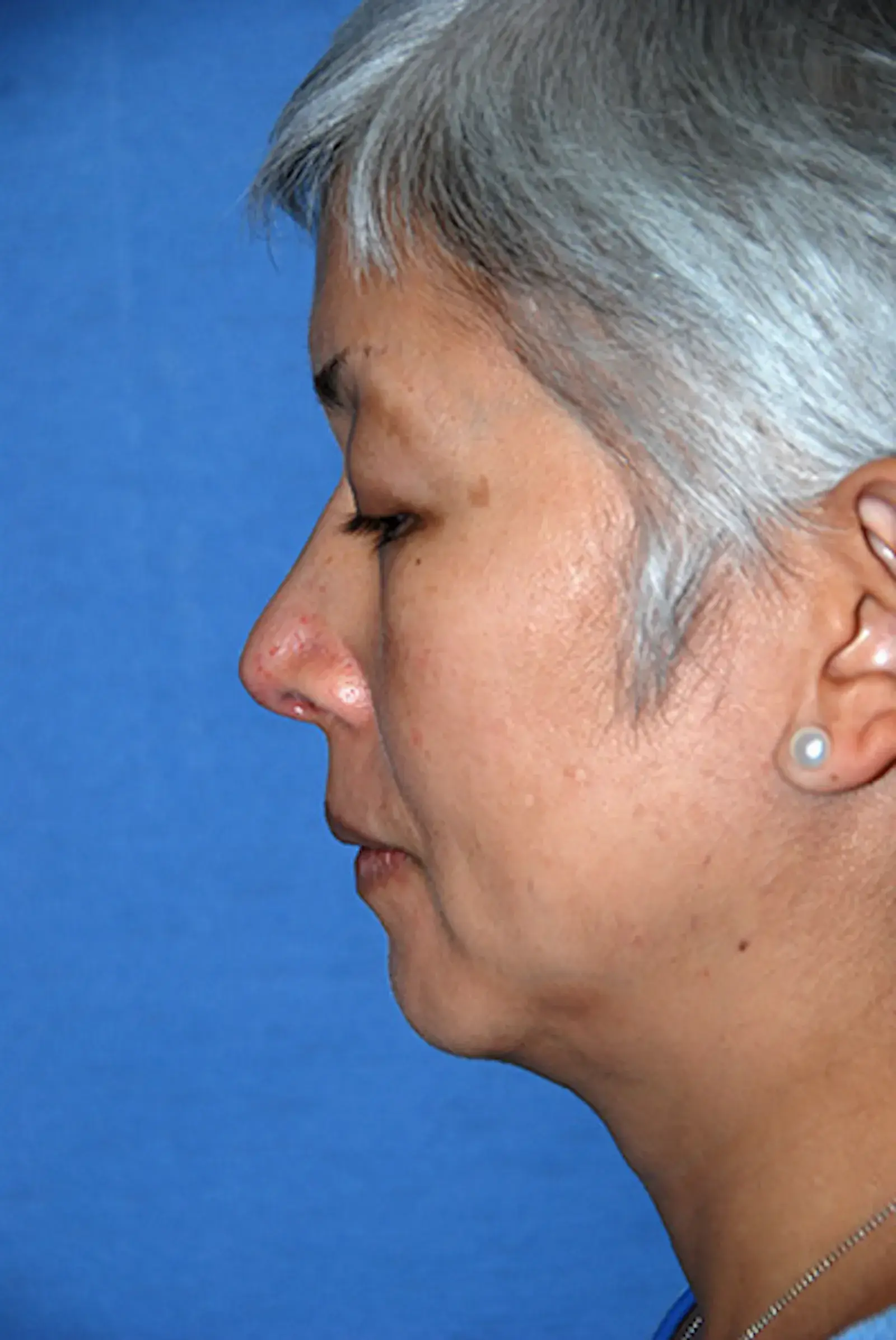 Aesthetic Facial Plastic Surgery – Dr. Philip Young MD rhinoplasty after — Bellevue, WA