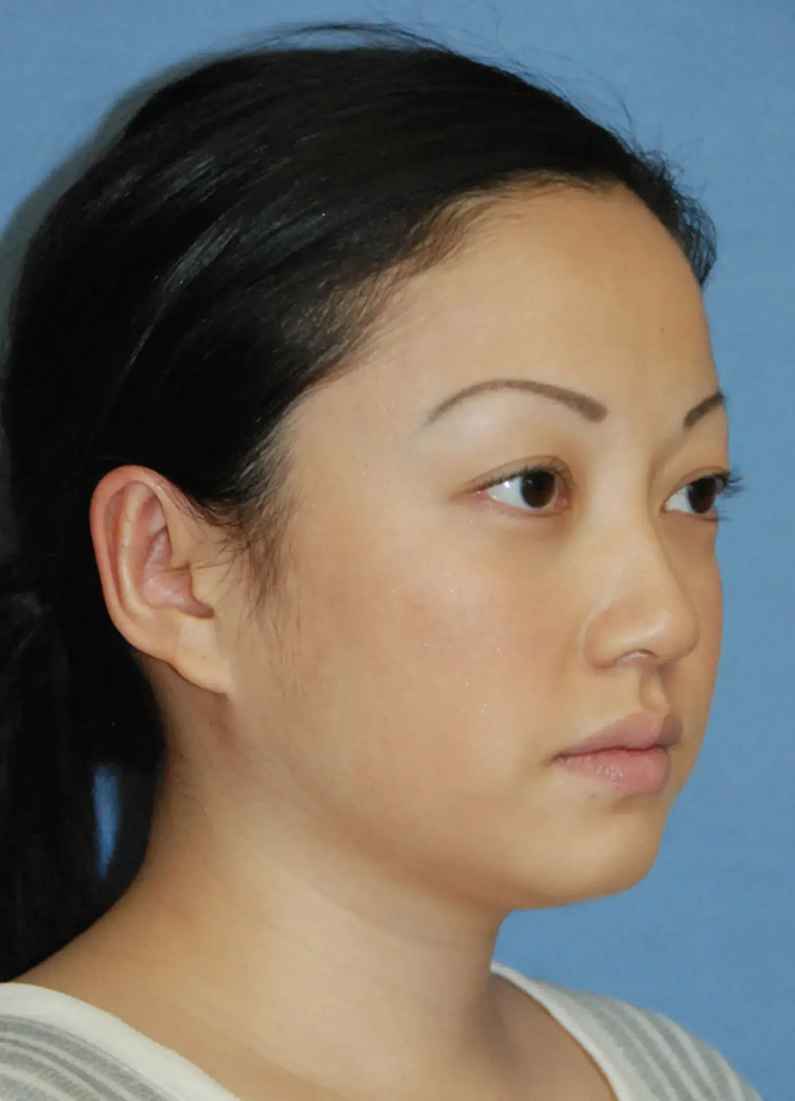 Aesthetic Facial Plastic Surgery – Dr. Philip Young MD rhinoplasty after — Bellevue, WA