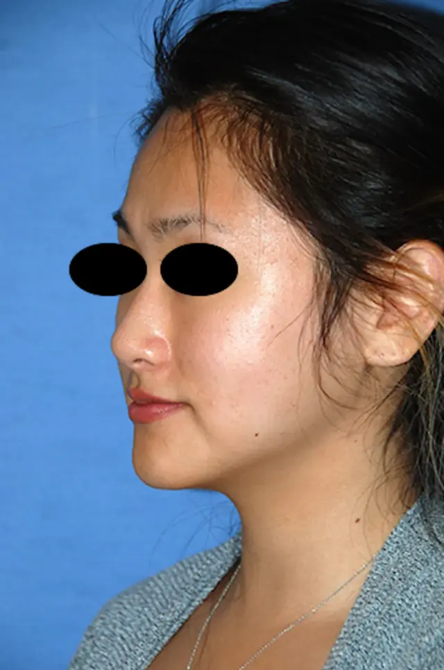 Chin Implant after at Aesthetic Facial Plastic Surgery – Dr. Philip Young MD in Bellevue, WA