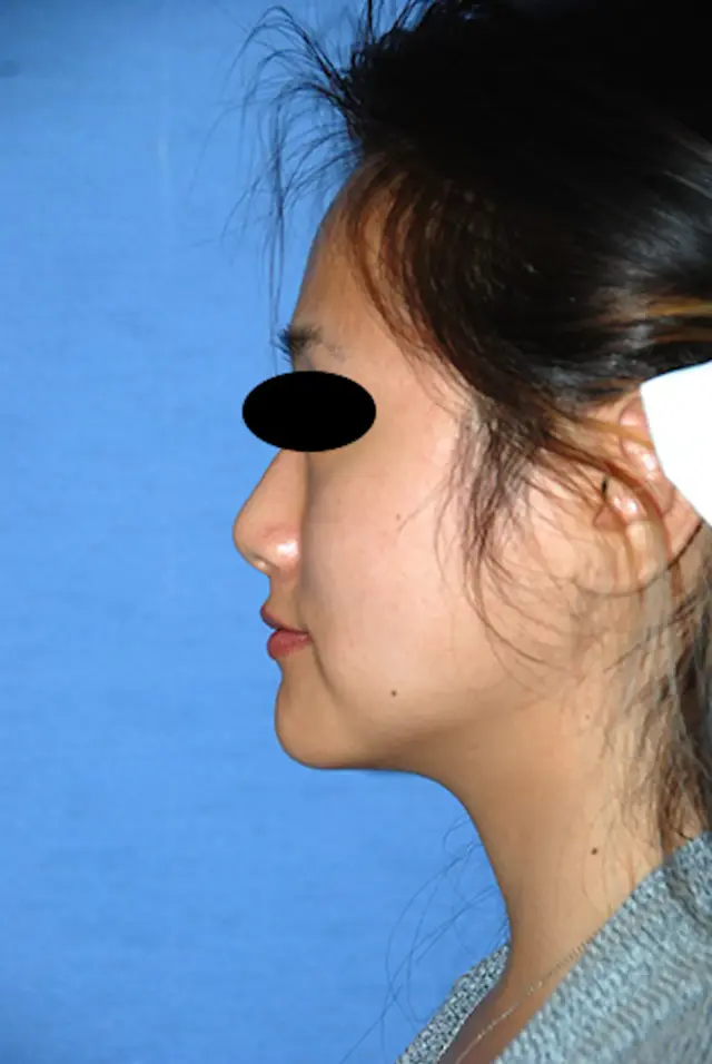 Chin Implant after at Aesthetic Facial Plastic Surgery – Dr. Philip Young MD in Bellevue, WA