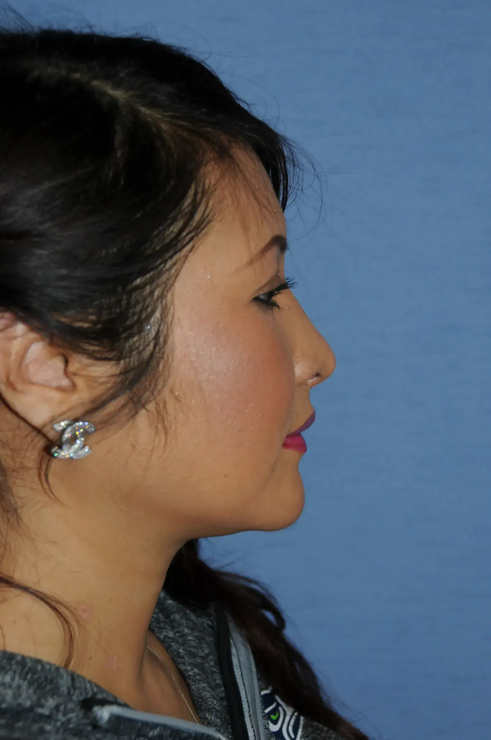 Aesthetic Facial Plastic Surgery – Dr. Philip Young MD rhinoplasty after — Bellevue, WA