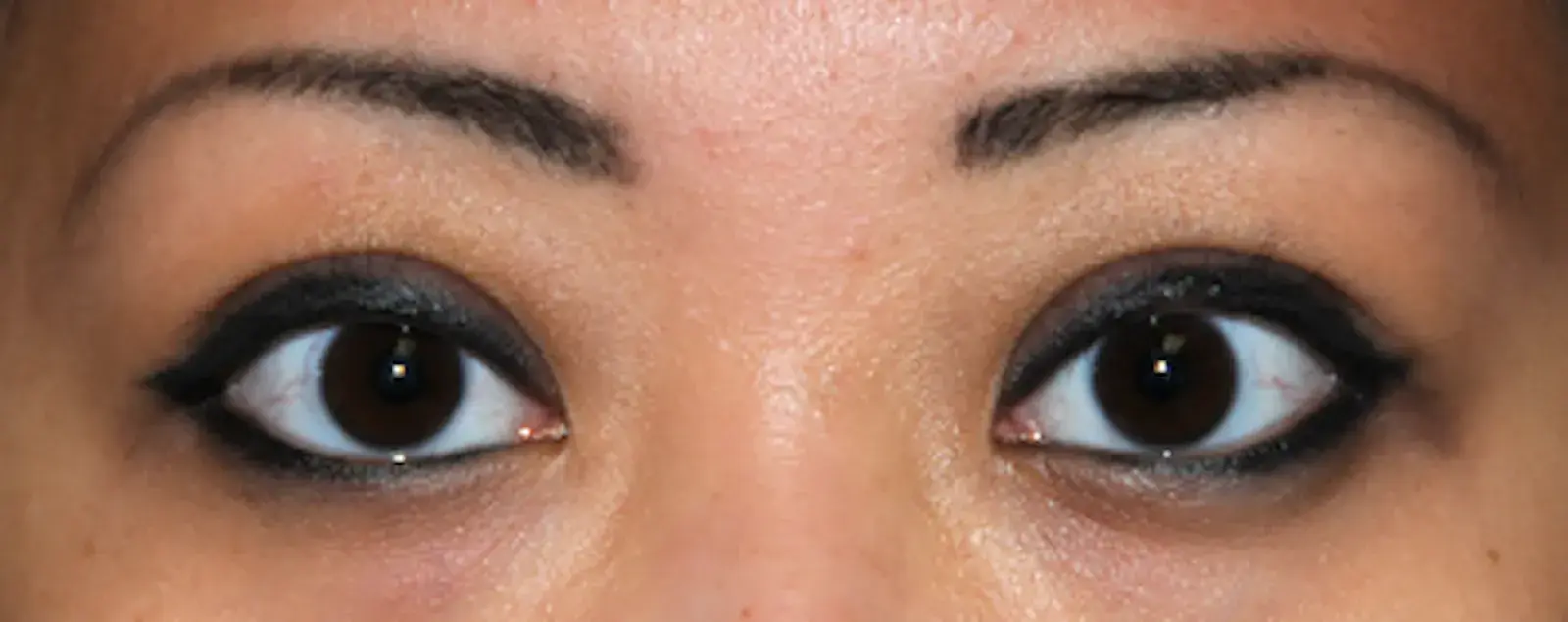 Aesthetic Facial Plastic Surgery – Dr. Philip Young MD eyelid lift after — Bellevue, WA