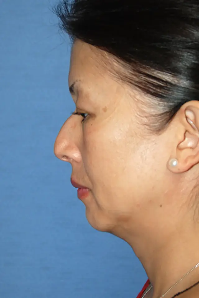 Rhinoplasty before at Aesthetic Facial Plastic Surgery – Dr. Philip Young MD in Bellevue, WA