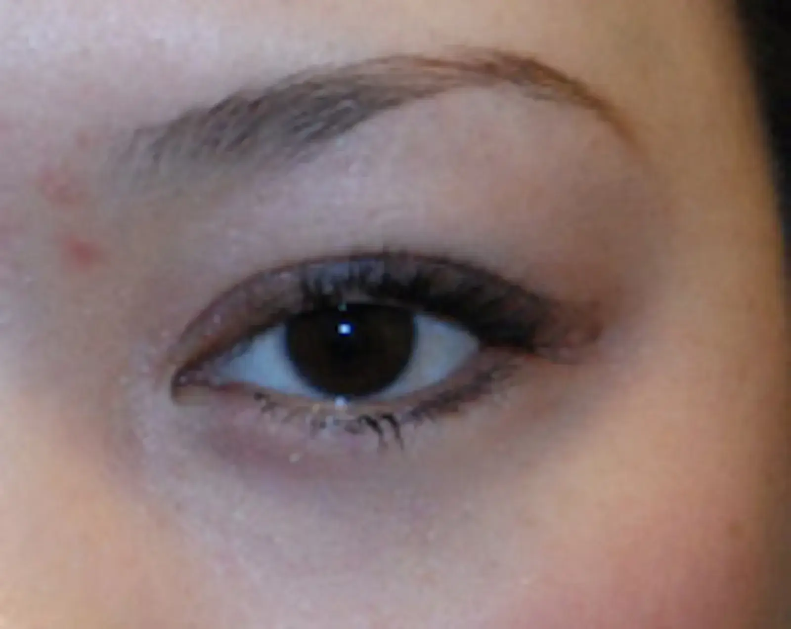Aesthetic Facial Plastic Surgery – Dr. Philip Young MD eyelid lift after — Bellevue, WA
