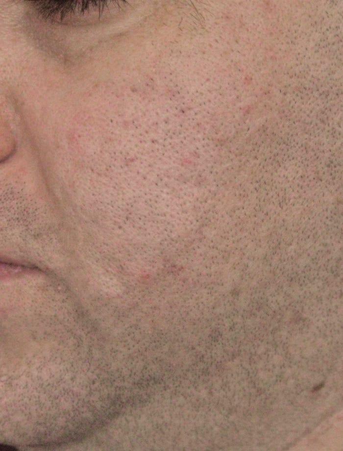 Aesthetic Facial Plastic Surgery – Dr. Philip Young MD after — Bellevue, WA