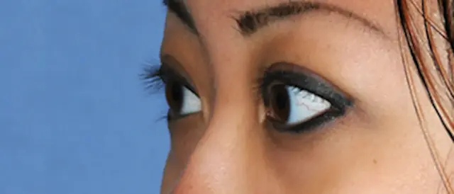 Blepharoplasty after at Aesthetic Facial Plastic Surgery – Dr. Philip Young MD in Bellevue, WA