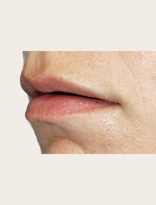 Lip Filler before at Aesthetic Facial Plastic Surgery – Dr. Philip Young MD in Bellevue, WA