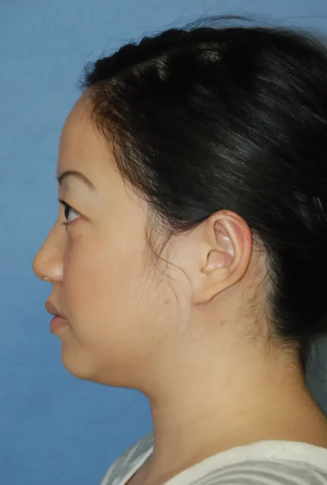 Rhinoplasty after at Aesthetic Facial Plastic Surgery – Dr. Philip Young MD in Bellevue, WA