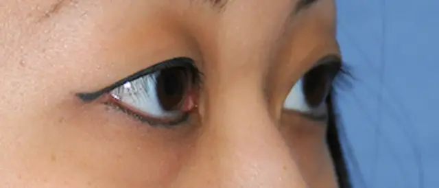 Blepharoplasty before at Aesthetic Facial Plastic Surgery – Dr. Philip Young MD in Bellevue, WA
