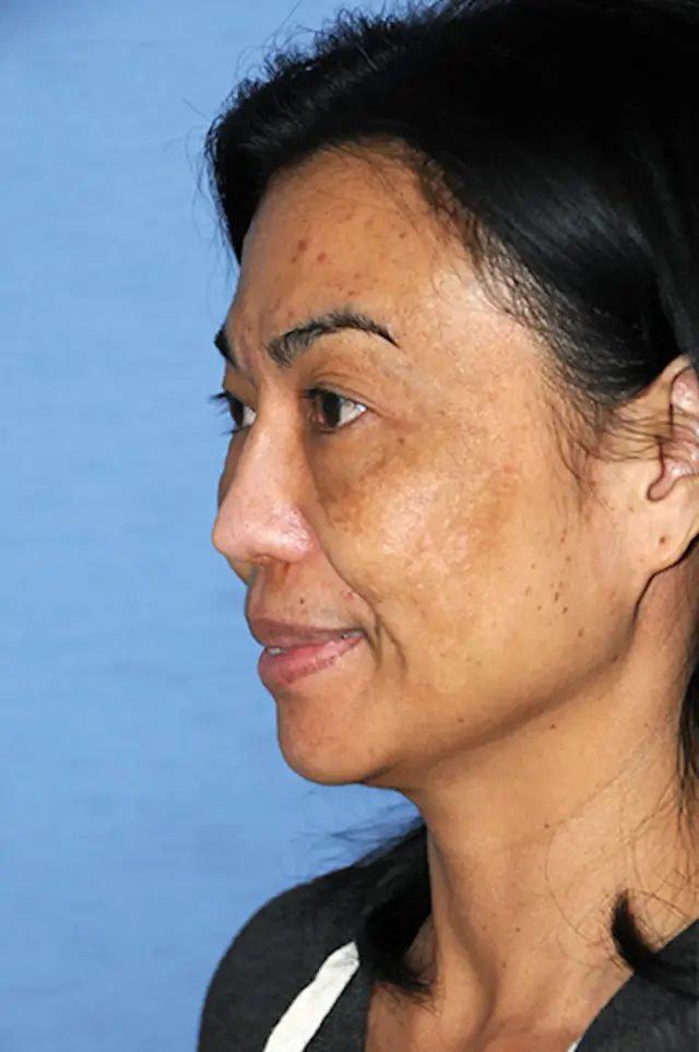 Deep Plane Facelift before at Aesthetic Facial Plastic Surgery – Dr. Philip Young MD in Bellevue, WA