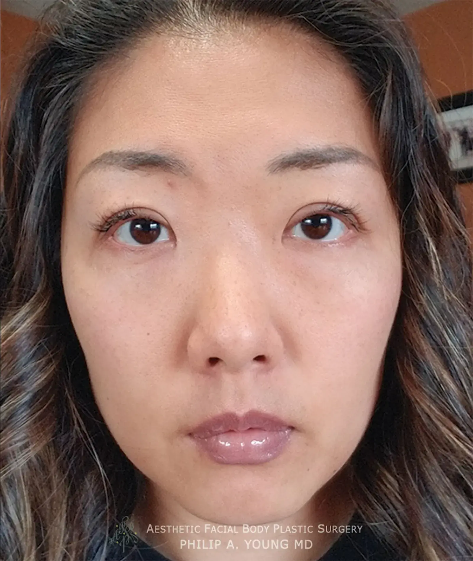 Aesthetic Facial Plastic Surgery – Dr. Philip Young MD eyelid lift after — Bellevue, WA