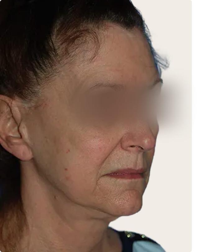 Deep Plane Facelift before at Aesthetic Facial Plastic Surgery – Dr. Philip Young MD in Bellevue, WA