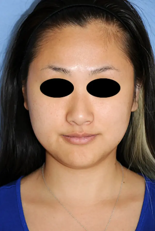 Chin Implant before at Aesthetic Facial Plastic Surgery – Dr. Philip Young MD in Bellevue, WA