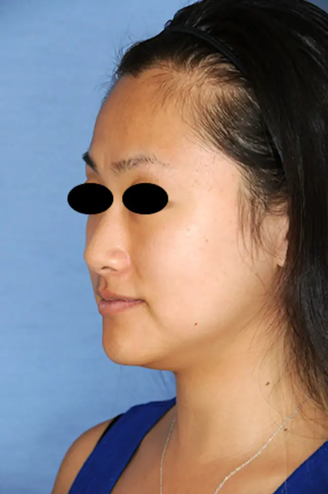 Chin Implant before at Aesthetic Facial Plastic Surgery – Dr. Philip Young MD in Bellevue, WA