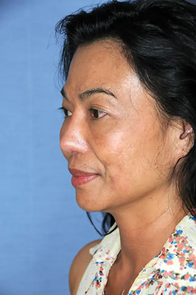 Deep Plane Facelift after at Aesthetic Facial Plastic Surgery – Dr. Philip Young MD in Bellevue, WA