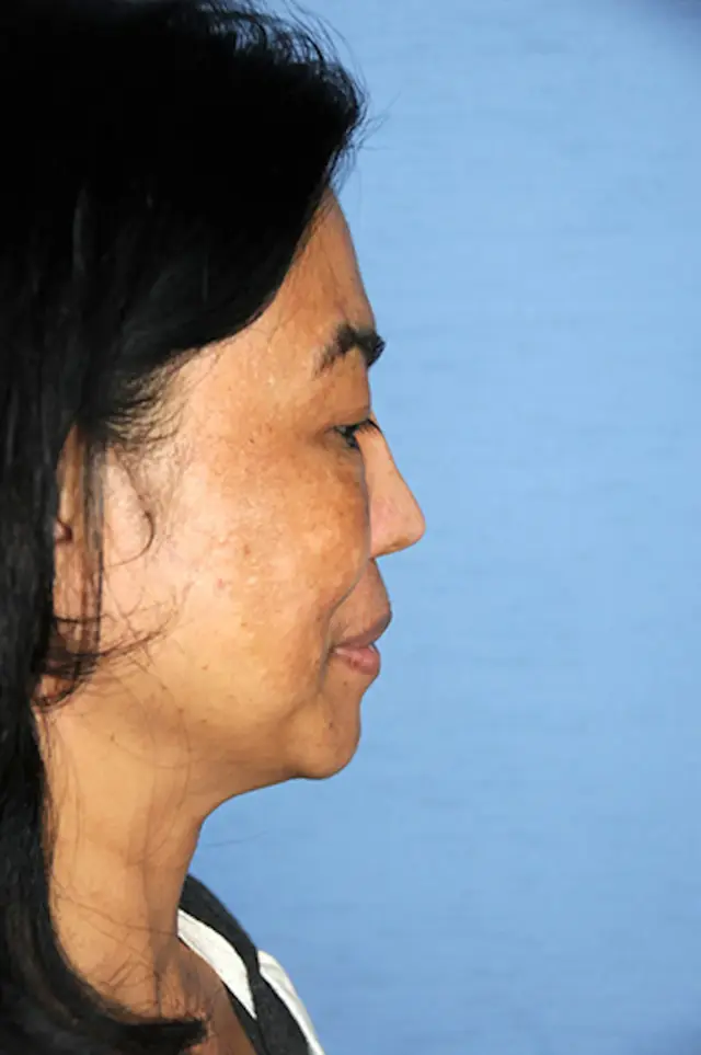 Deep Plane Facelift before at Aesthetic Facial Plastic Surgery – Dr. Philip Young MD in Bellevue, WA