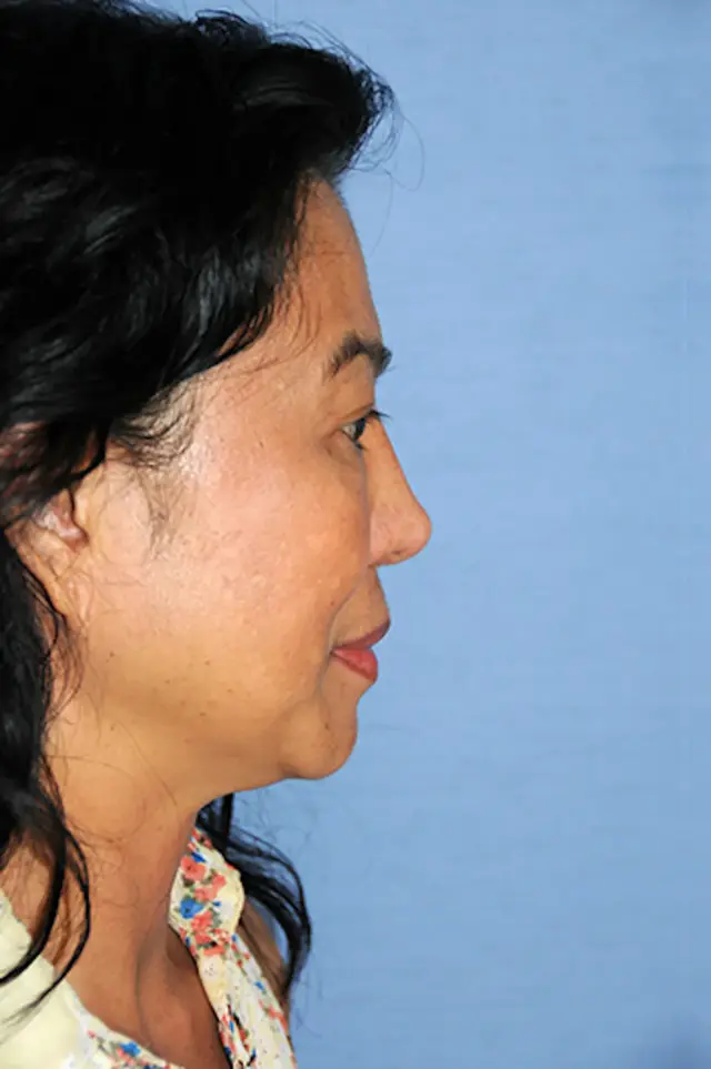 Deep Plane Facelift after at Aesthetic Facial Plastic Surgery – Dr. Philip Young MD in Bellevue, WA