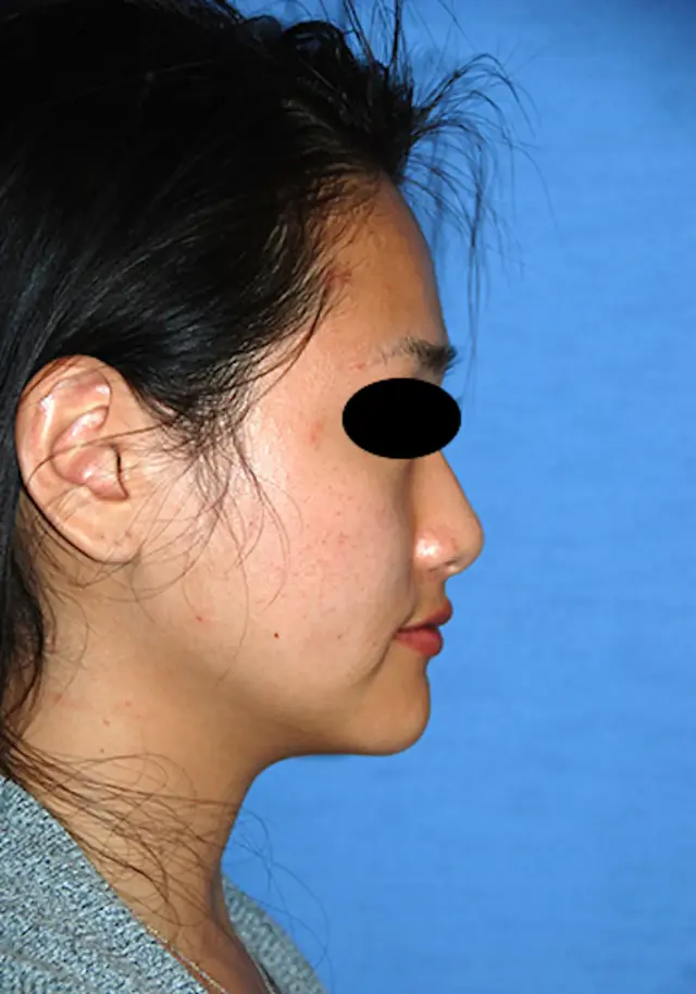 Chin Implant after at Aesthetic Facial Plastic Surgery – Dr. Philip Young MD in Bellevue, WA